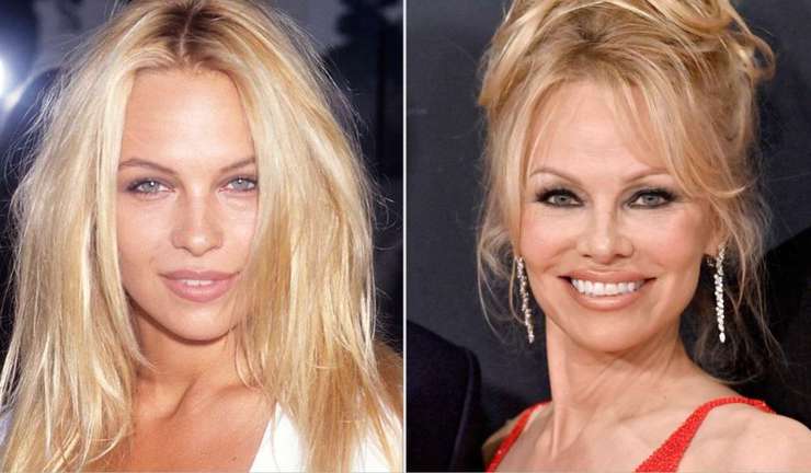 Миграция филлеров: почему лица Энистон и Дженнер опухшие и неровные Миграция филлеров: почему лица Энистон и Дженнер опухшие и неровные