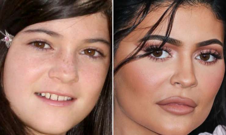 Миграция филлеров: почему лица Энистон и Дженнер опухшие и неровные Миграция филлеров: почему лица Энистон и Дженнер опухшие и неровные